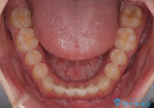 すきっ歯は放置NG?インビザラインで目立たず改善の治療中