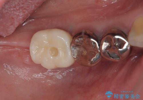 他院で抜歯をしたのでインプラントを入れたい　インプラント治療の症例 治療後