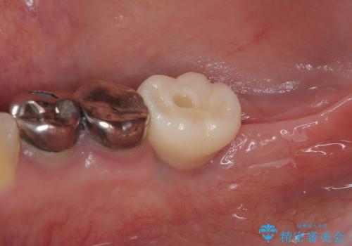 他院で抜歯をしたのでインプラントを入れたい　インプラント治療の治療後