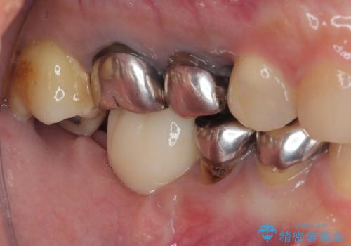 他院で抜歯をしたのでインプラントを入れたい　インプラント治療の治療後