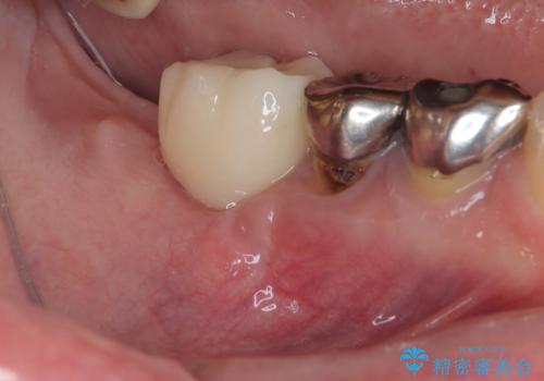 他院で抜歯をしたのでインプラントを入れたい インプラント治療の治療後