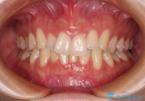 前歯が隠れるほどのデコボコをインビザライン矯正できれいに整えるの症例 治療前