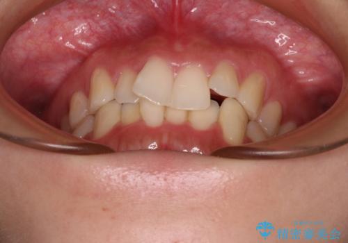 前歯が隠れるほどのデコボコをインビザライン矯正できれいに整えるの治療前