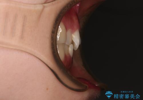 前歯が隠れるほどのデコボコをインビザライン矯正できれいに整えるの治療前