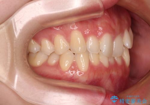 前歯が隠れるほどのデコボコをインビザライン矯正できれいに整えるの治療前