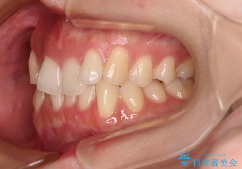 前歯が隠れるほどのデコボコをインビザライン矯正できれいに整えるの治療前