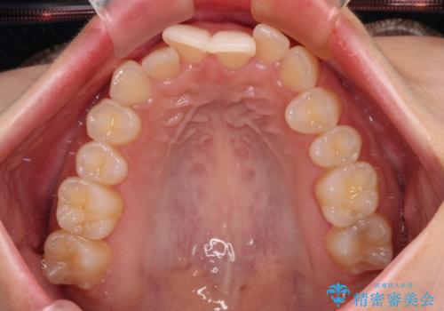 前歯が隠れるほどのデコボコをインビザライン矯正できれいに整えるの治療前
