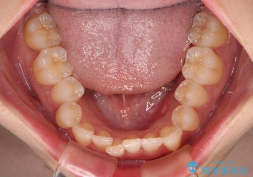 前歯が隠れるほどのデコボコをインビザライン矯正できれいに整えるの治療前