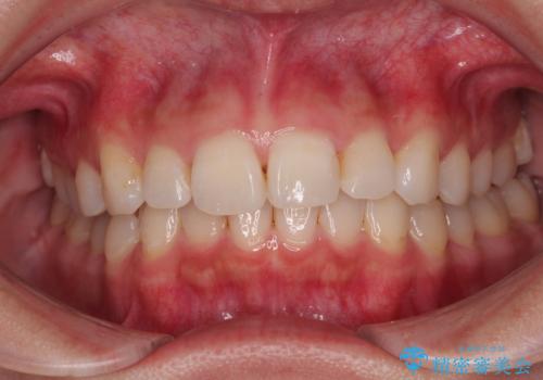 デコボコと咬み合わせを改善　インビザライン矯正治療の治療中