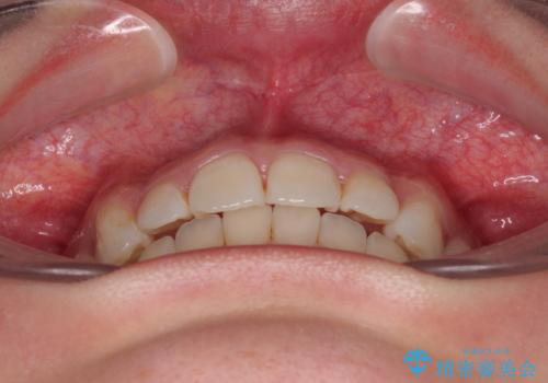 デコボコと咬み合わせを改善　インビザライン矯正治療の治療中