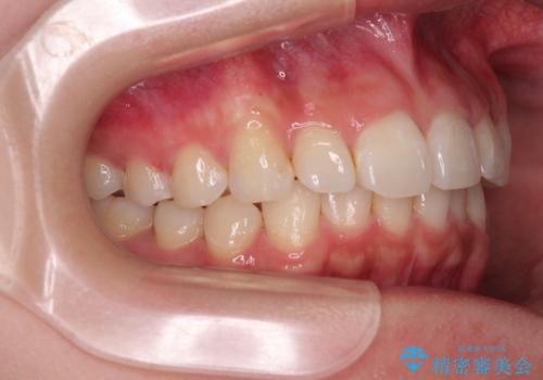 デコボコと咬み合わせを改善　インビザライン矯正治療の治療中