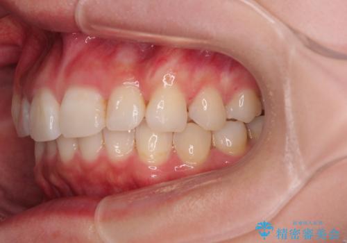 デコボコと咬み合わせを改善　インビザライン矯正治療の治療中
