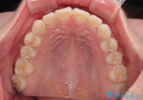 デコボコと咬み合わせを改善 インビザライン矯正治療の治療中