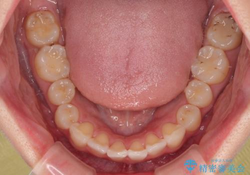 デコボコと咬み合わせを改善 インビザライン矯正治療の治療中