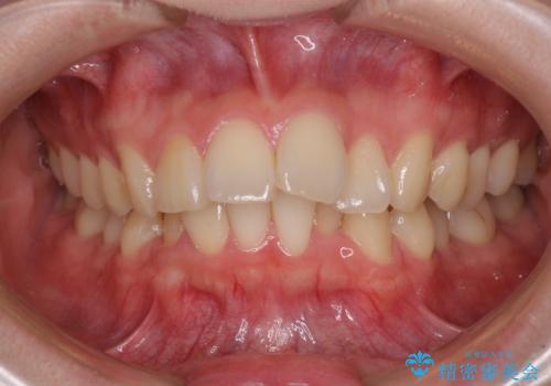 深い咬み合わせと飛び出した前歯　ワイヤー装置での抜歯矯正治療の治療前