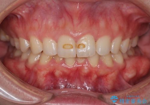 【インビザラインとワイヤー矯正】がたつきと噛み合わせを改善!の症例 治療前