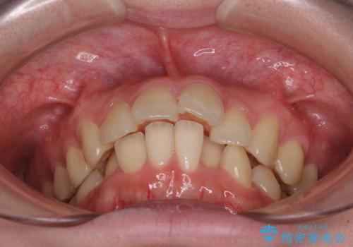 深い咬み合わせと飛び出した前歯　ワイヤー装置での抜歯矯正治療の治療前