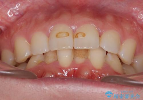 【インビザラインとワイヤー矯正】がたつきと噛み合わせを改善!の治療前