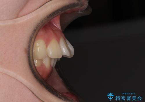 深い咬み合わせと飛び出した前歯 ワイヤー装置での抜歯矯正治療の治療前