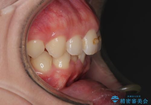 【インビザラインとワイヤー矯正】がたつきと噛み合わせを改善!の治療前