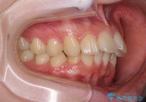 深い咬み合わせと飛び出した前歯　ワイヤー装置での抜歯矯正治療の治療前
