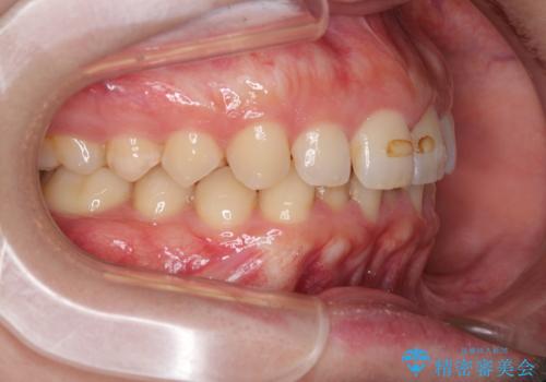 【インビザラインとワイヤー矯正】がたつきと噛み合わせを改善!の治療前