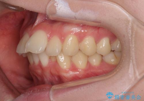 深い咬み合わせと飛び出した前歯　ワイヤー装置での抜歯矯正治療の治療前