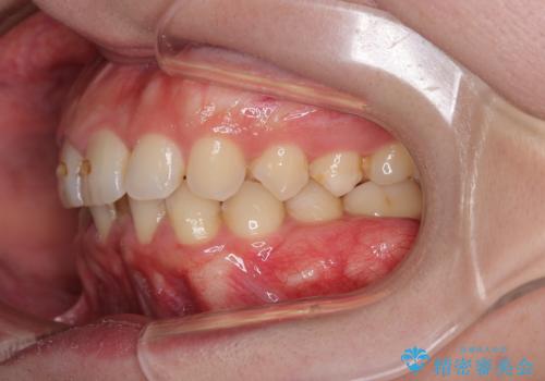 【インビザラインとワイヤー矯正】がたつきと噛み合わせを改善!の治療前