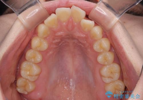 深い咬み合わせと飛び出した前歯 ワイヤー装置での抜歯矯正治療の治療前