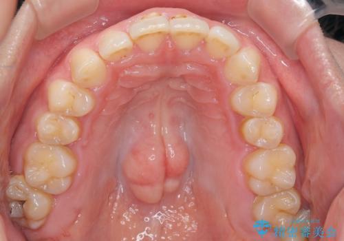 【インビザラインとワイヤー矯正】がたつきと噛み合わせを改善!の治療前
