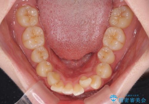 深い咬み合わせと飛び出した前歯 ワイヤー装置での抜歯矯正治療の治療前