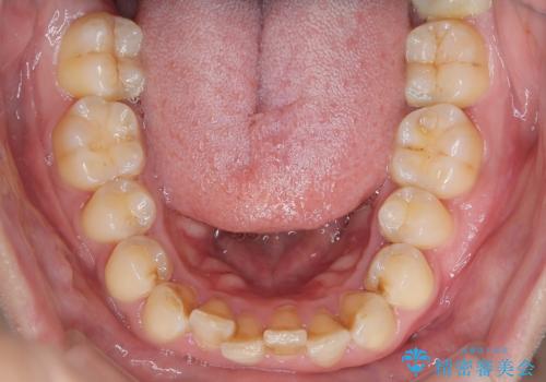 【インビザラインとワイヤー矯正】がたつきと噛み合わせを改善!の治療前