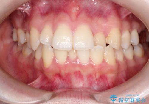 【ワイヤー矯正】口元を下げたい、下の歯の凹凸を無くしたいの治療前