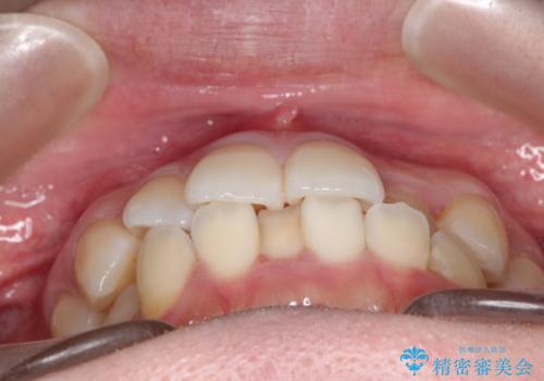 【ワイヤー矯正】口元を下げたい、下の歯の凹凸を無くしたいの治療前