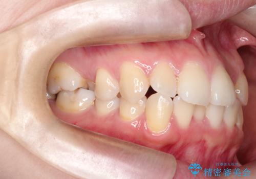 【ワイヤー矯正】口元を下げたい、下の歯の凹凸を無くしたいの治療前