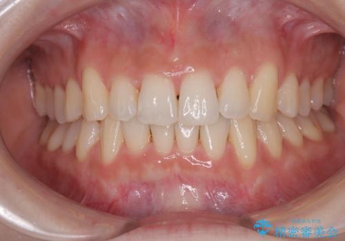 前歯が隠れるほどのデコボコをインビザライン矯正できれいに整えるの治療中