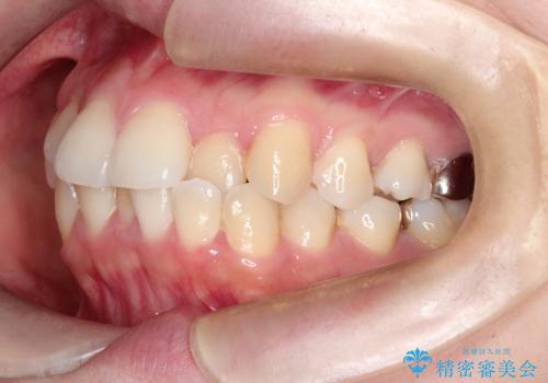 【ワイヤー矯正】口元を下げたい、下の歯の凹凸を無くしたいの治療前