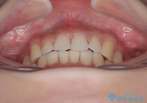 前歯が隠れるほどのデコボコをインビザライン矯正できれいに整えるの治療中