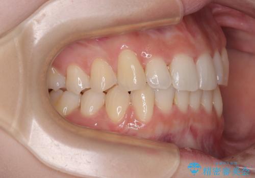 前歯が隠れるほどのデコボコをインビザライン矯正できれいに整えるの治療中