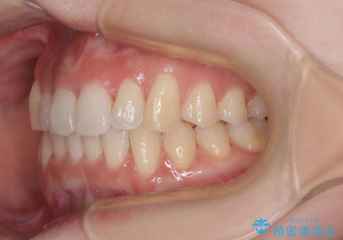 前歯が隠れるほどのデコボコをインビザライン矯正できれいに整えるの治療中