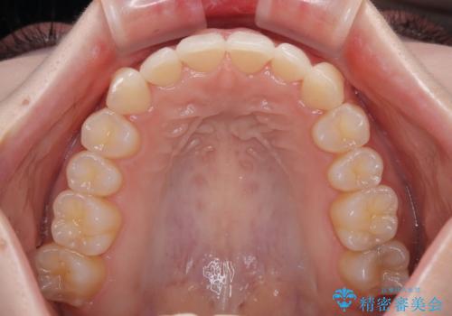 前歯が隠れるほどのデコボコをインビザライン矯正できれいに整えるの治療中
