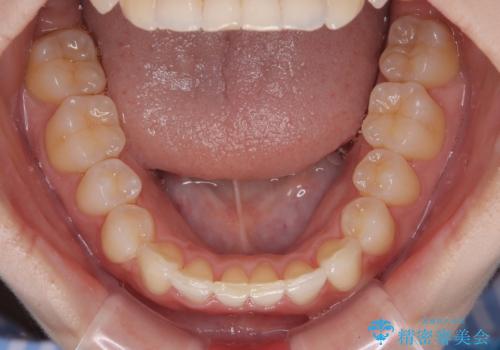 前歯が隠れるほどのデコボコをインビザライン矯正できれいに整えるの治療中