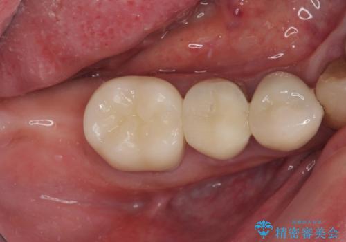 破折してしまった奥歯　抜歯即時埋入で短期間インプラント治療の症例 治療前