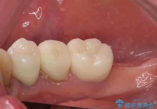 破折してしまった奥歯　抜歯即時埋入で短期間インプラント治療の治療前