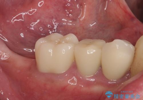 破折してしまった奥歯 抜歯即時埋入で短期間インプラント治療の治療前