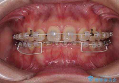 隠れた前歯が気になる ディープバイトのワイヤー矯正治療の治療中