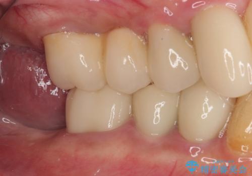 破折してしまった奥歯 抜歯即時埋入で短期間インプラント治療の治療前