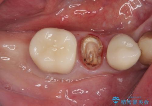 破折してしまった奥歯 抜歯即時埋入で短期間インプラント治療の治療前