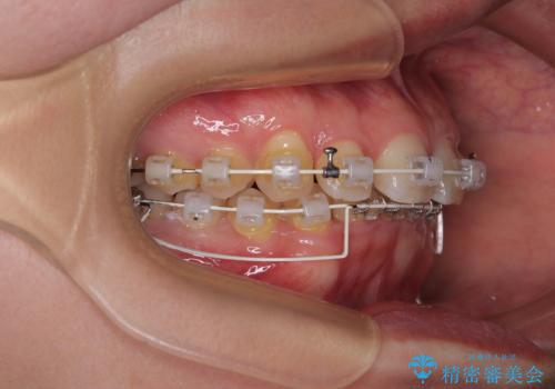 隠れた前歯が気になる　ディープバイトのワイヤー矯正治療の治療中