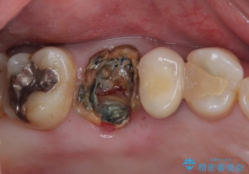 割れてしまった奥歯　1DAYインプラント治療の治療前